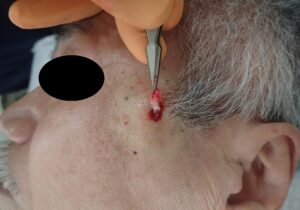 Intraoperative Image: Removal of Epidermoid Cyst Capsule on the Cheek (2 cm) - 粉瘤(アテローム) | こおりたひろ整形形成外科クリニック - 痛みの少ない粉瘤治療で多数の実績|大阪| Intraoperative photo of capsule removal from a 2 cm epidermoid cyst on the cheek