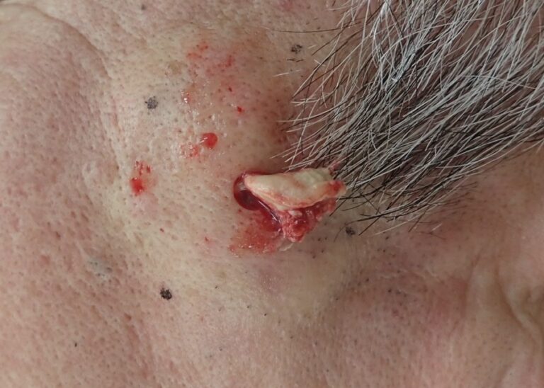 Intraoperative photo of capsule removal from a 2 cm epidermoid cyst on the cheek