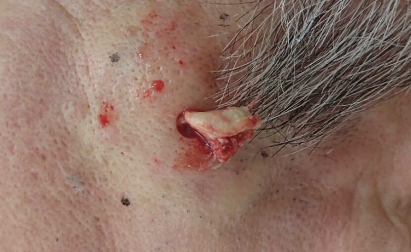 Intraoperative photo of capsule removal from a 2 cm epidermoid cyst on the cheek