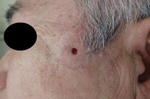 Postoperative Day 1 After Cheek Epidermoid Cyst Removal - 粉瘤(アテローム) | こおりたひろ整形形成外科クリニック - 痛みの少ない粉瘤治療で多数の実績|大阪| Day 1 postoperative photo after removal of an epidermoid cyst on the cheek