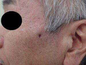 Postoperative Day 5 After Cheek Epidermoid Cyst Removal – No Swelling, Pain, or Infection - 粉瘤(アテローム) | こおりたひろ整形形成外科クリニック - 痛みの少ない粉瘤治療で多数の実績|大阪| Postoperative Day 5 After Cheek Epidermoid Cyst Removal – No Swelling, Pain, or Infection
