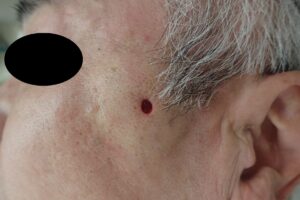 Postoperative Image: Capsule Removal of 2 cm Epidermoid Cyst on the Cheek - 粉瘤(アテローム) | こおりたひろ整形形成外科クリニック - 痛みの少ない粉瘤治療で多数の実績|大阪| Postoperative photo of capsule removal from a 2 cm epidermoid cyst on the cheek
