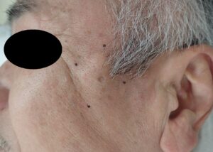 Preoperative Image of Epidermoid Cyst (Atheroma) - 粉瘤(アテローム) | こおりたひろ整形形成外科クリニック - 痛みの少ない粉瘤治療で多数の実績|大阪| Preoperative photo of an epidermoid cyst located on the cheek