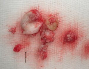 Excised atheroma capsule. Cleanly and completely removed.