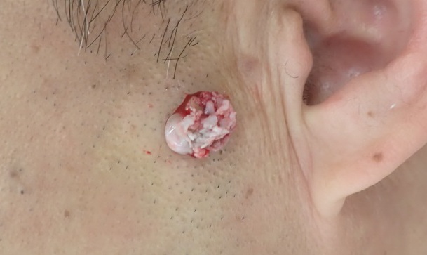 Close-up photo during punch excision of a facial epidermoid cyst in a man in his 50s, showing the cyst capsule being separated.