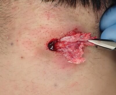 Intraoperative image showing the careful removal of the cyst wall using punch excision