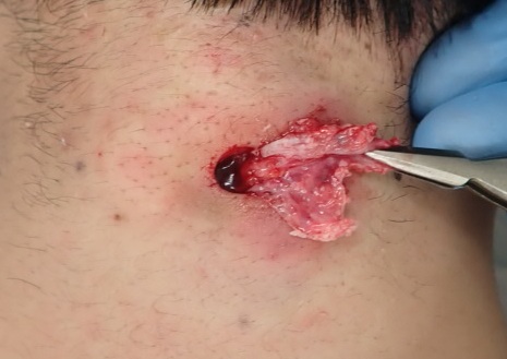 Intraoperative image showing the careful removal of the cyst wall using punch excision