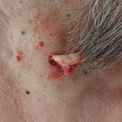 頬部にできた約2cmの粉瘤の被膜を摘出している術中写真