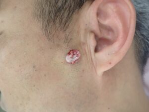 顔の粉瘤 被膜摘出中(50代男性)|くりぬき法・なつい式湿潤療法 - 粉瘤(アテローム) | こおりたひろ整形形成外科クリニック - 痛みの少ない粉瘤治療で多数の実績|大阪| 50代男性 顔の粉瘤をくりぬき法で摘出中。被膜を丁寧に除去している様子。