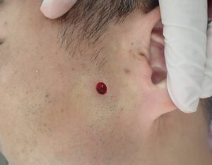 顔の粉瘤 術直後(50代男性)|出血ほぼなし・くりぬき法 - 粉瘤(アテローム) | こおりたひろ整形形成外科クリニック - 痛みの少ない粉瘤治療で多数の実績|大阪| 50代男性 顔の粉瘤をくりぬき法で摘出した直後の写真(出血ほぼなし
