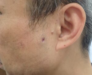 顔の粉瘤 術後15日目(50代男性)|違和感なく日常生活へ - 粉瘤(アテローム) | こおりたひろ整形形成外科クリニック - 痛みの少ない粉瘤治療で多数の実績|大阪| 50代男性 顔の粉瘤摘出後15日目。腫れや痛みなどの症状は全くなし。