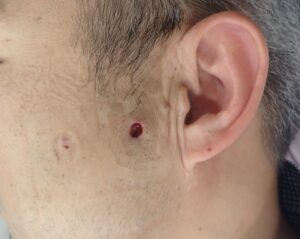 顔の粉瘤 術後1日目(50代男性)|出血ほぼ無し - 粉瘤(アテローム) | こおりたひろ整形形成外科クリニック - 痛みの少ない粉瘤治療で多数の実績|大阪| 術後1日目の顔の粉瘤の創部写真。出血はほぼ認められません。