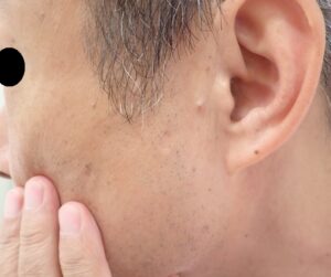顔の粉瘤 術後1年目(50代男性)|傷跡ほぼ分からず自然な仕上がり - 粉瘤(アテローム) | こおりたひろ整形形成外科クリニック - 痛みの少ない粉瘤治療で多数の実績|大阪| 50代男性 顔の粉瘤摘出後1年目。傷跡はほぼ分からず自然な皮膚状態。