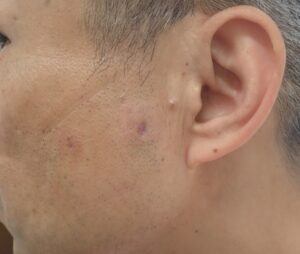 顔の粉瘤 術後21日目(50代男性)|創部は完全に治癒 - 粉瘤(アテローム) | こおりたひろ整形形成外科クリニック - 痛みの少ない粉瘤治療で多数の実績|大阪| 50代男性 顔の粉瘤摘出後21日目の写真。傷は治癒し、症状はなし。