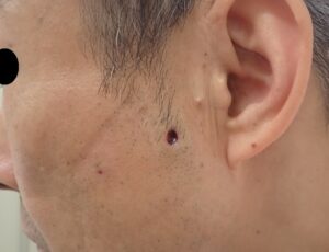 顔の粉瘤 術後7日目(50代男性)|腫れ・痛みなし - 粉瘤(アテローム) | こおりたひろ整形形成外科クリニック - 痛みの少ない粉瘤治療で多数の実績|大阪| 50代男性 顔の粉瘤摘出後7日目の写真。腫れや痛みは認められない