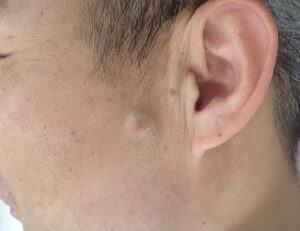 顔の粉瘤 術前写真(50代男性)|くりぬき法・なつい式湿潤療法 - 粉瘤(アテローム) | こおりたひろ整形形成外科クリニック - 痛みの少ない粉瘤治療で多数の実績|大阪| 50代男性 顔の粉瘤の術前状態