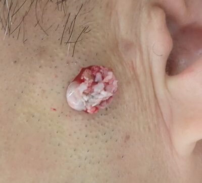 50代男性 顔の粉瘤をくりぬき法で摘出中。被膜が鮮明に見えるアップ写真