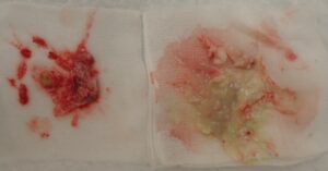 術直後に摘出された粉瘤の内容物と被膜 - 粉瘤(アテローム) | こおりたひろ整形形成外科クリニック - 痛みの少ない粉瘤治療で多数の実績|大阪| くりぬき法で摘出された粉瘤の内容物と袋(被膜)の写真