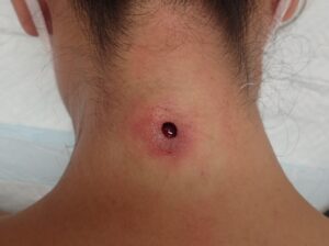炎症性粉瘤の摘出直後の創部。くりぬき法で手術を行いました。 - 粉瘤(アテローム) | こおりたひろ整形形成外科クリニック - 痛みの少ない粉瘤治療で多数の実績|大阪| 頚部に生じた炎症性粉瘤摘出後の術直後の創部。くりぬき法により袋まで除去済み。