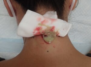 炎症を起こした頚部の粉瘤。術中、内容物を排出している様子。 - 粉瘤(アテローム) | こおりたひろ整形形成外科クリニック - 痛みの少ない粉瘤治療で多数の実績|大阪| 炎症性の頚部粉瘤から膿様の内容物を排出している術中写真
