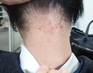 粉瘤摘出術後4年目|傷跡ほぼ消失の経過写真 - 粉瘤(アテローム) | こおりたひろ整形形成外科クリニック - 痛みの少ない粉瘤治療で多数の実績|大阪| なつい式くりぬき法で粉瘤を摘出してから4年後の写真。傷跡はほとんど目立ちません。