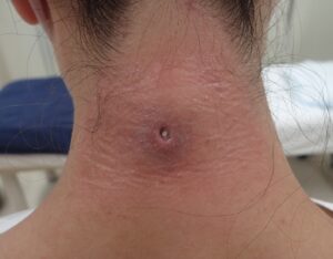 炎症性粉瘤摘出術後4日目の創部。発赤も改善し、痛み・感染なし。 - 粉瘤(アテローム) | こおりたひろ整形形成外科クリニック - 痛みの少ない粉瘤治療で多数の実績|大阪| 炎症性粉瘤摘出術後4日目の頚部創部。発赤軽減、痛みや感染なし。