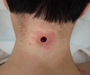 粉瘤摘出手術直後の創部写真 - 粉瘤(アテローム) | こおりたひろ整形形成外科クリニック - 痛みの少ない粉瘤治療で多数の実績|大阪| くりぬき法で粉瘤を摘出した直後の傷口の様子