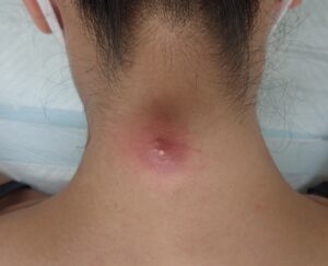 赤く腫れて痛みのある頚部の粉瘤。術前の状態です。 - 粉瘤(アテローム) | こおりたひろ整形形成外科クリニック - 痛みの少ない粉瘤治療で多数の実績|大阪| 赤く腫れて炎症を起こしている頚部の粉瘤(アテローム)の術前写真