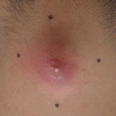 腫れて赤くなった頚部粉瘤の術前写真