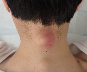 頚部に炎症と痛みを伴う粉瘤の術前写真(くりぬき法+湿潤療法予定) - 粉瘤(アテローム) | こおりたひろ整形形成外科クリニック - 痛みの少ない粉瘤治療で多数の実績|大阪| 赤く腫れて痛みを伴う頚部の炎症性粉瘤の術前写真です。くりぬき法で手術予定です。
