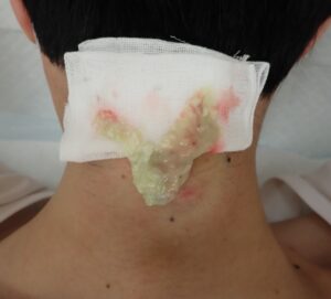 Intraoperative photo of neck epidermoid cyst with contents being expressed (punch excision) - 粉瘤(アテローム) | こおりたひろ整形形成外科クリニック - 痛みの少ない粉瘤治療で多数の実績|大阪| Photo showing intraoperative expression of keratinous contents from a neck epidermoid cyst during punch excision.