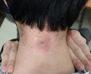 Postoperative Day 12 After Cyst Removal|No Infection, Almost Healed - 粉瘤(アテローム) | こおりたひろ整形形成外科クリニック - 痛みの少ない粉瘤治療で多数の実績|大阪| Healing wound on Day 12 after punch excision of an epidermoid cyst, no redness or pain