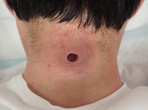Day 1 Postoperative Wound After Epidermoid Cyst Removal - 粉瘤(アテローム) | こおりたひろ整形形成外科クリニック - 痛みの少ない粉瘤治療で多数の実績|大阪| Wound condition on Day 1 after punch excision of an epidermoid cyst (Natsui-style moist wound therapy)