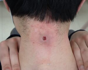 Postoperative Day 5 After Epidermoid Cyst Removal - 粉瘤(アテローム) | こおりたひろ整形形成外科クリニック - 痛みの少ない粉瘤治療で多数の実績|大阪| Wound on Day 5 after punch excision of epidermoid cyst; no signs of infection or pain