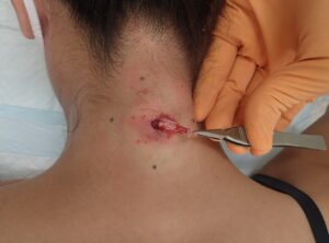 Inflamed sebaceous cyst on the neck – intraoperative removal of the cyst wall. - 粉瘤(アテローム) | こおりたひろ整形形成外科クリニック - 痛みの少ない粉瘤治療で多数の実績|大阪| Intraoperative photo of the cyst wall being removed from an inflamed sebaceous (epidermoid) cyst on the neck using punch excision.