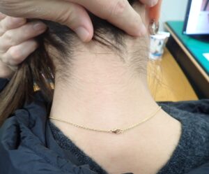 Five years after removal of inflamed sebaceous cyst – no visible scar, no symptoms. - 粉瘤(アテローム) | こおりたひろ整形形成外科クリニック - 痛みの少ない粉瘤治療で多数の実績|大阪| Five-year postoperative image of the neck after punch excision of an inflamed sebaceous cyst. No visible scar, no recurrence.