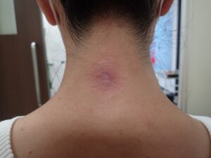 Postoperative day 14 after removal of inflamed sebaceous cyst – nearly healed, no pain or infection. - 粉瘤(アテローム) | こおりたひろ整形形成外科クリニック - 痛みの少ない粉瘤治療で多数の実績|大阪| Day 14 postoperative image of the neck following punch excision of an inflamed sebaceous cyst. Wound nearly healed; no pain or infection.