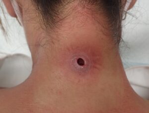 Postoperative day 2 after removal of inflamed sebaceous cyst – no pain or signs of infection. - 粉瘤(アテローム) | こおりたひろ整形形成外科クリニック - 痛みの少ない粉瘤治療で多数の実績|大阪| Postoperative day 2 image of the neck after punch excision of an inflamed sebaceous cyst. No pain or signs of infection.