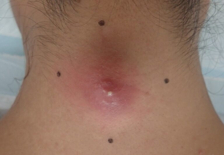 Swollen and red epidermoid cyst on the neck before surgery