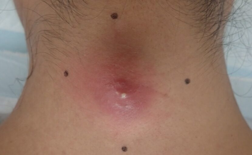 Swollen and red epidermoid cyst on the neck before surgery