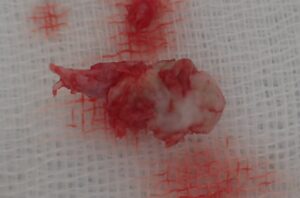 Excised Capsule of Neck Epidermoid Cyst|Specimen After Punch Excision - 粉瘤(アテローム) | こおりたひろ整形形成外科クリニック - 痛みの少ない粉瘤治療で多数の実績|大阪| Excised capsule (cyst wall) of a neck epidermoid cyst. The intact sac was removed via punch excision.