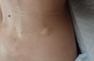 Preoperative Photo of Neck Epidermoid Cyst|Antibiotics Failed, Surgery Planned - 粉瘤(アテローム) | こおりたひろ整形形成外科クリニック - 痛みの少ない粉瘤治療で多数の実績|大阪| Pre-op image of a neck epidermoid cyst. The patient was initially prescribed antibiotics at another clinic, but the swelling worsened, leading to surgical referral.