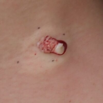 Close-up intraoperative image of a neck epidermoid cyst being removed via punch excision. The cyst capsule is emerging through the excision site.