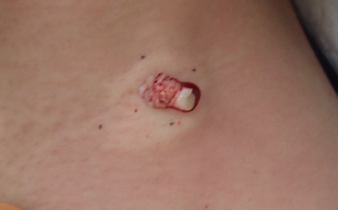 Close-up intraoperative image of a neck epidermoid cyst being removed via punch excision. The cyst capsule is emerging through the excision site.