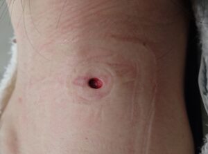 Day 1 After Epidermoid Cyst Excision|No Swelling, Bleeding, or Infection - 粉瘤(アテローム) | こおりたひろ整形形成外科クリニック - 痛みの少ない粉瘤治療で多数の実績|大阪| Postoperative image on day 1 after epidermoid cyst excision. No signs of swelling, bleeding, or infection. The patient reports minimal pain.