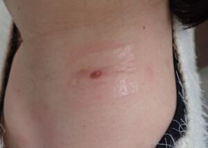 Day 4 After Epidermoid Cyst Excision|No Swelling, Bleeding, or Infection - 粉瘤(アテローム) | こおりたひろ整形形成外科クリニック - 痛みの少ない粉瘤治療で多数の実績|大阪| Postoperative day 4 image after epidermoid cyst excision. No swelling, bleeding, infection, or pain. The wound is healing well.