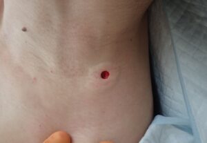 頚部粉瘤（アテローム）をくりぬき法で摘出した直後の写真です。出血は最小限にとどまっています。