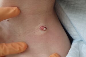 頚部粉瘤（アテローム）の手術中の写真です。くりぬき法により内部の被膜が露出してきている様子が確認できます。