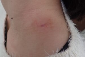 粉瘤（アテローム）摘出手術から19日経過した傷の写真。腫れ、出血、感染、痛みは認められず、傷もほぼ治癒している。