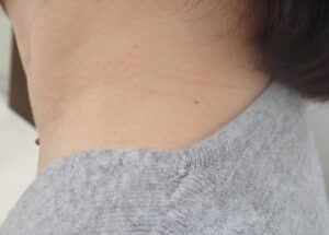 粉瘤（アテローム）摘出手術から5年経過した部位の写真。症状の再発はなく、傷跡もほとんど目立たない。